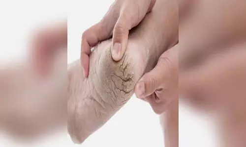 सर्दियों में त्वचा और एड़ियों का फटना, कैसे करें इसका इलाज, किन चीजों से हो सकता है बचाव सर्दियों में त्वचा और एड़ियों का फटना, कैसे करें इसका इलाज, किन चीजों से हो सकता है बचाव