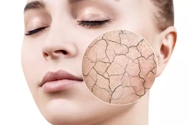 Dry Skin के इलाज के लिए 5 आसान घरेलू उपाय