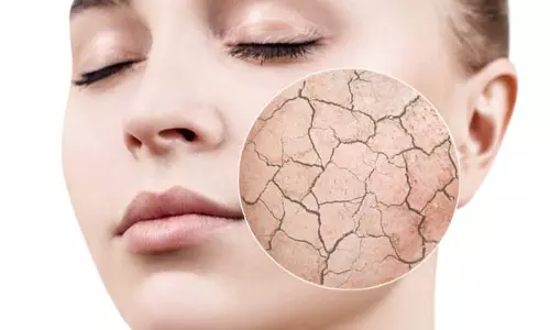 Dry Skin के इलाज के लिए 5 आसान घरेलू उपाय Dry Skin के इलाज के लिए 5 आसान घरेलू उपाय