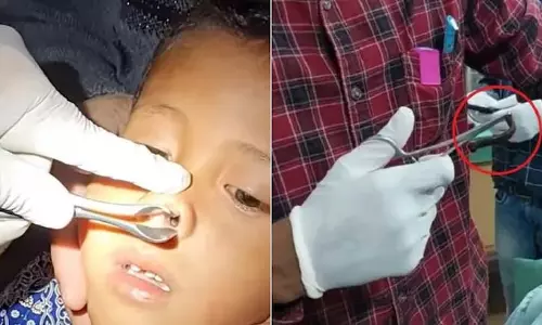 OMG! बच्चे के नाक से डॉक्टरों ने निकाला जोंक, देखें VIDEO...