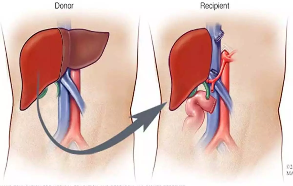 Good news... नागपुर में लिवर ट्रांसप्लांट सेंटर.. गरीबों के लिए सरकार...