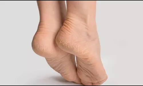 Lifestyle: फटी एड़ियों से निजात पाने के लिए घर में बनाकर रख लें वैक्स क्रीम