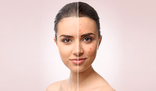 Lifestyle: चेहरे के दाग-धब्बों से हैं परेशान, इस्तेमाल करें यही ओवरनाइट फेस मास्क