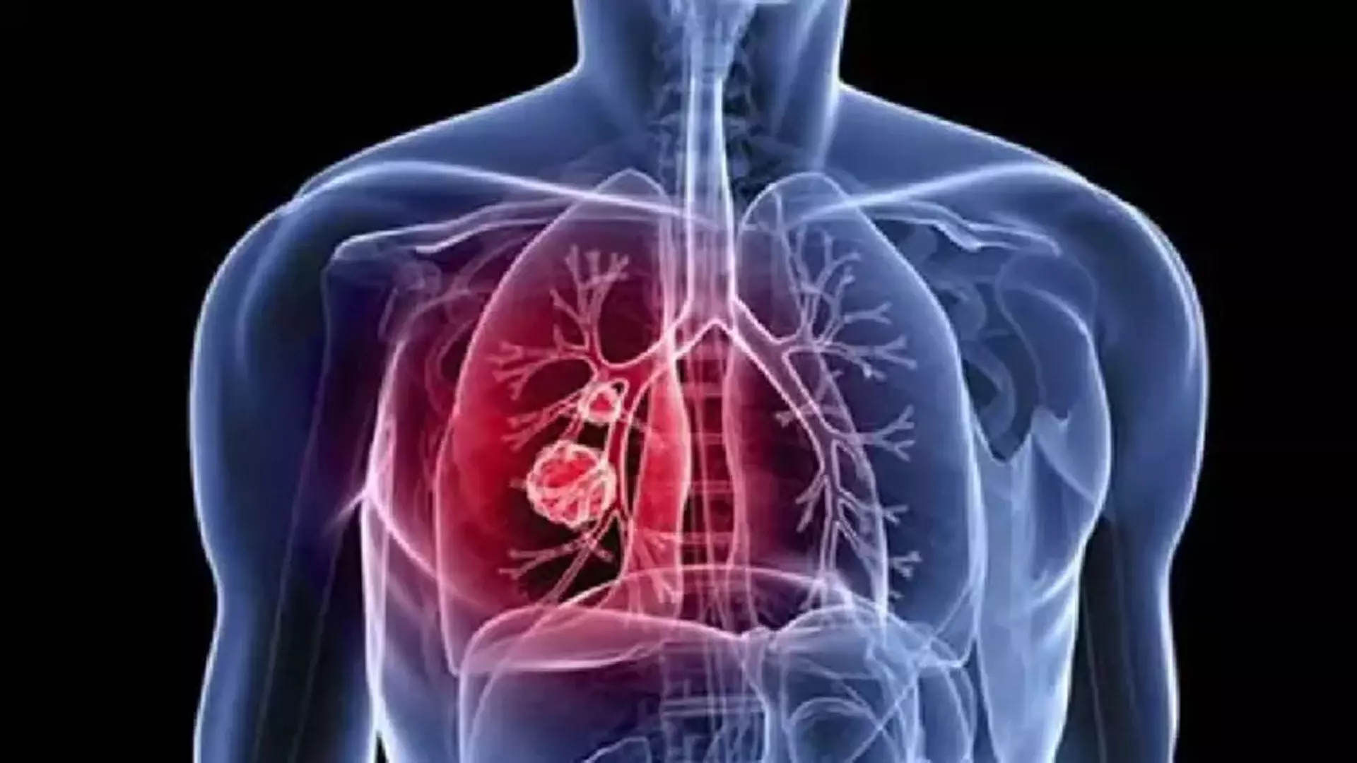 Lung Cancer को समझना: जागरूकता, जोखिम और लक्षण