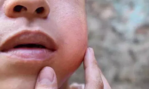 Kerala में स्कूली छात्रों में मम्प्स का प्रकोप विशेषज्ञों को नए प्रकार का संदेह