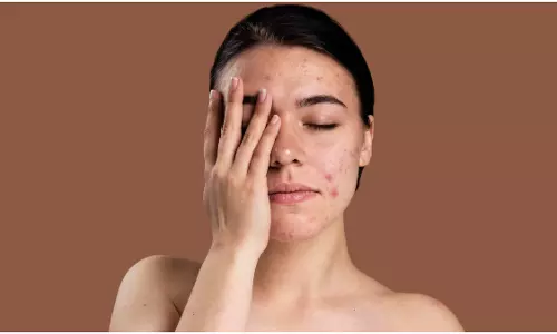 Lifestyle: बेदाग और मुंहासे मुक्त त्वचा पाने के लिए फॉलो करें यह टिप्स