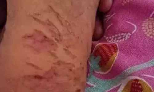 ये क्या हो गया! हॉस्टल की लापरवाही...लकवे का शिकार हुई छात्रा