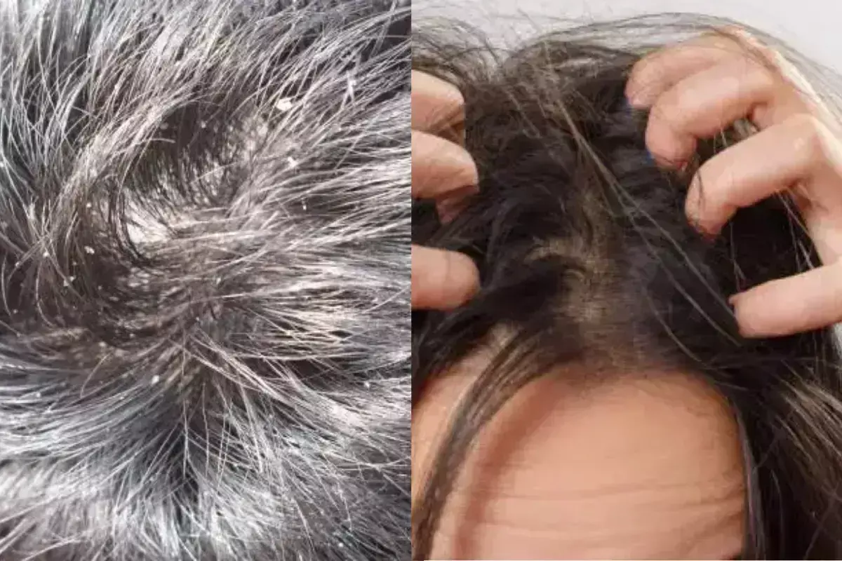 Lifestyle: सर्दियों में डैंड्रफ से पीछा छुड़ाने के लिए रोज़ाना इस खास तेल का इस्तेमाल करे Lifestyle: सर्दियों में डैंड्रफ से पीछा छुड़ाने के लिए रोज़ाना इस खास तेल का इस्तेमाल करे