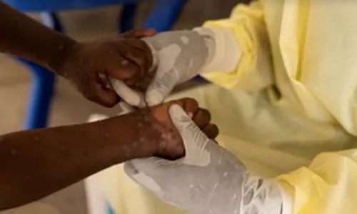 अफ्रीका में एमपॉक्स के मामले 70,000 के करीब पहुंचे: Africa CDC