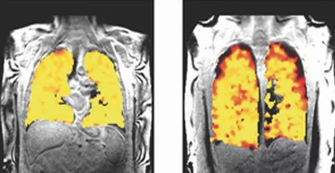 वैज्ञानिकों ने विकसित की फेफड़ों को स्कैन करने की नई विधि