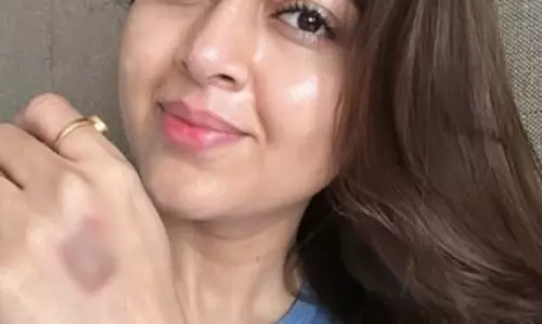 Tejasswi Prakash को सेट पर लगी चोट Tejasswi Prakash को सेट पर लगी चोट