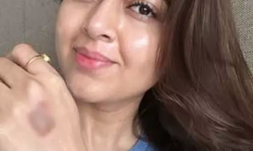 सेलिब्रिटी मास्टरशेफ के सेट पर घायल हुईं तेजस्वी प्रकाश, सोशल मीडिया पर प्रशंसकों को दी जानकारी