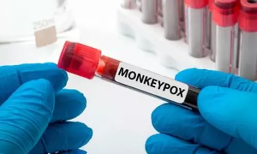 Ampox: बेंगलुरू में 2025 का पहला मामला सामने आया, 40 वर्षीय व्यक्ति ने यात्रा की थी