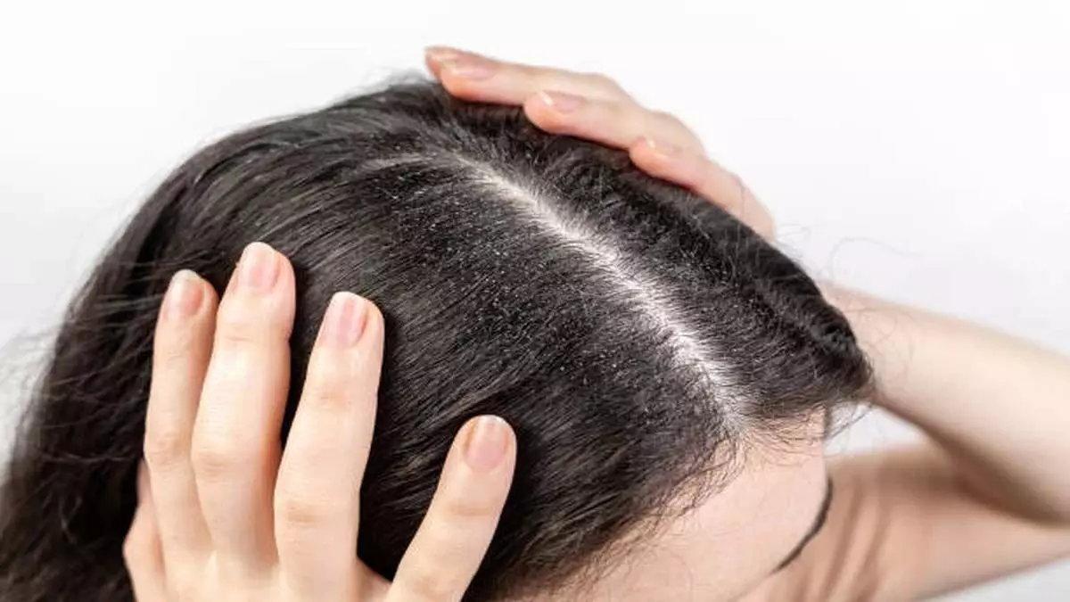 Dandruff Remedy: डैंड्रफ से छुटकारा पाने के लिए जैतून के तेल में मिलाकर लगाएं ये चीजें