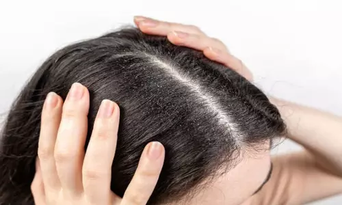 Dandruff Remedy: डैंड्रफ से छुटकारा पाने के लिए जैतून के तेल में मिलाकर लगाएं ये चीजें Dandruff Remedy: डैंड्रफ से छुटकारा पाने के लिए जैतून के तेल में मिलाकर लगाएं ये चीजें