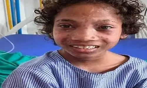 बच्ची में आई जान, झुलस गई थी IED ब्लास्ट में