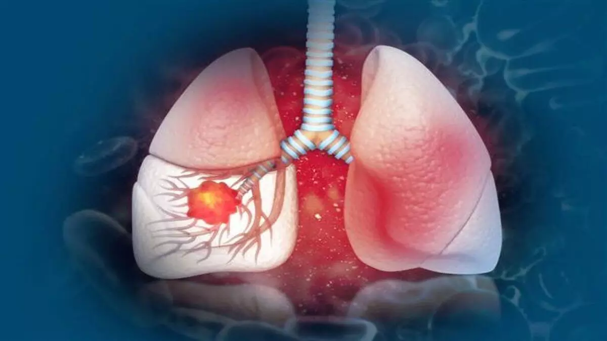 धूम्रपान न करने वालों में फेफड़े के कैंसर के मामले बढ़ रहे हैं- Lancet study