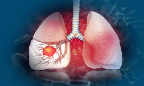 धूम्रपान न करने वालों में फेफड़े के कैंसर के मामले बढ़ रहे हैं- Lancet study