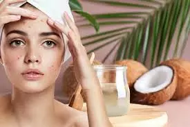Lifestyle: चेहरे के दाग-धब्बे नहीं जा रहे, नारियल के तेल में मिलाकर लगायें यह चीजें Lifestyle: चेहरे के दाग-धब्बे नहीं जा रहे, नारियल के तेल में मिलाकर लगायें यह चीजें