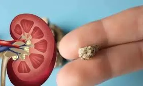 Health: किडनी स्टोन के लक्षण हैं पीठ के निचले हिस्से, पेट या बाजू में दर्द,फॉलो करें ये डाइट चार्ट