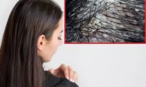 Lifestyle: सर के डैंड्रफ से छुटकारा पाने के लिए बालों में लगायें घर की रसोई में रखीं चीजें Lifestyle: सर के डैंड्रफ से छुटकारा पाने के लिए बालों में लगायें घर की रसोई में रखीं चीजें