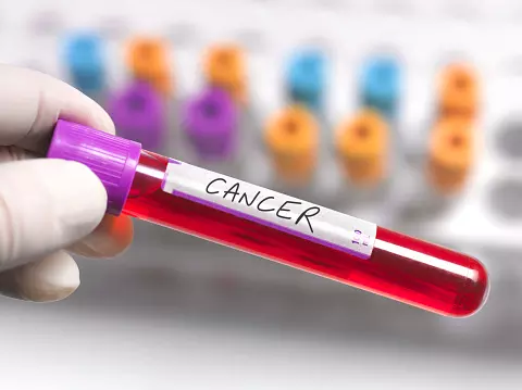 Health News: भारत में अल्कोहल की वजह से बढ़ रहे कैंसर मरीज Health News: भारत में अल्कोहल की वजह से बढ़ रहे कैंसर मरीज