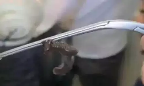 जीएमसी अनंतनाग ने 9 सेमी जोंक को हटाया