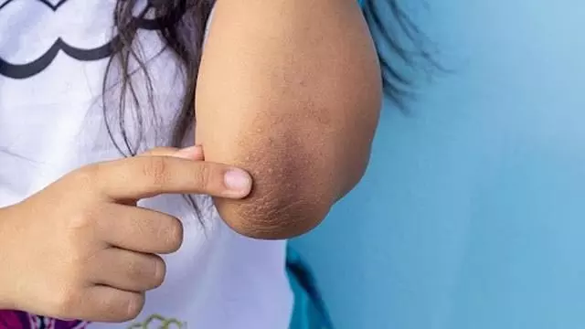 Skin care: इन घरेलू उपायों से काली कोहनियों को कहें अलविदा Skin care: इन घरेलू उपायों से काली कोहनियों को कहें अलविदा