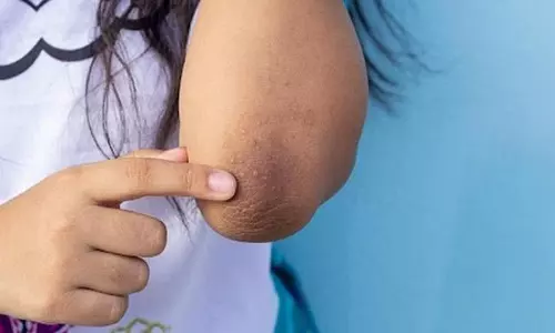 Skin care: इन घरेलू उपायों से काली कोहनियों को कहें अलविदा Skin care: इन घरेलू उपायों से काली कोहनियों को कहें अलविदा