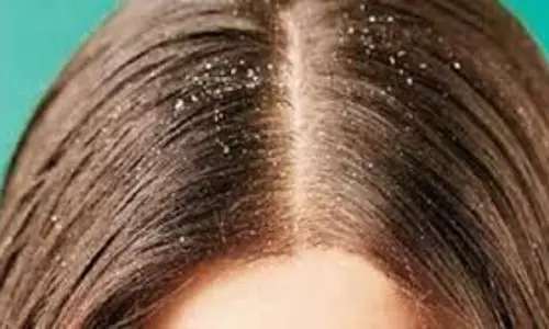 Beauty : डैंड्रफ की समस्या है ज्यादा, बचने के लिए आजमाएं ये उपाय Beauty : डैंड्रफ की समस्या है ज्यादा, बचने के लिए आजमाएं ये उपाय