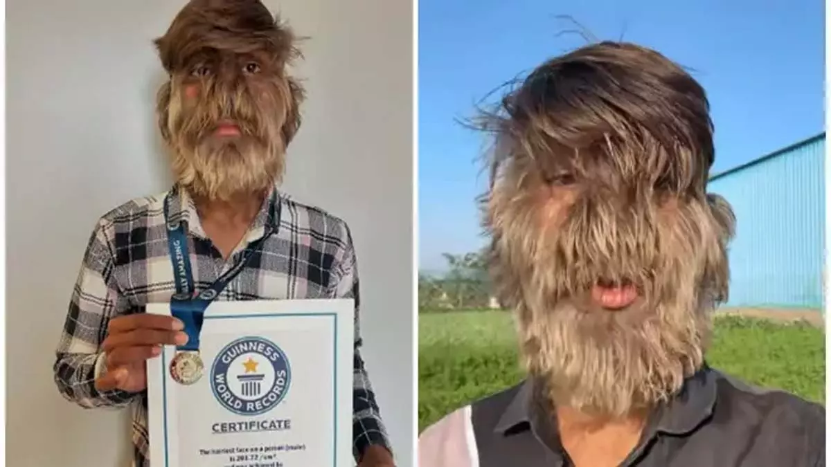 वेयरवोल्फ सिंड्रोम से पीड़ित 18 वर्षीय भारतीय युवक ने बनाया गिनीज वर्ल्ड रिकॉर्ड वेयरवोल्फ सिंड्रोम से पीड़ित 18 वर्षीय भारतीय युवक ने बनाया गिनीज वर्ल्ड रिकॉर्ड