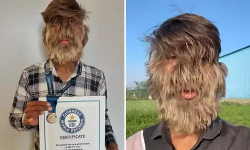 वेयरवोल्फ सिंड्रोम से पीड़ित 18 वर्षीय भारतीय युवक ने बनाया गिनीज वर्ल्ड रिकॉर्ड वेयरवोल्फ सिंड्रोम से पीड़ित 18 वर्षीय भारतीय युवक ने बनाया गिनीज वर्ल्ड रिकॉर्ड