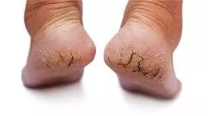 Lifestyle: गर्मियों में भी फटी एड़ियां करती हैं परेशान, इन घरेलू उपायों से पाएं राहत Lifestyle: गर्मियों में भी फटी एड़ियां करती हैं परेशान, इन घरेलू उपायों से पाएं राहत
