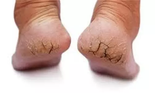Lifestyle: गर्मियों में भी फटी एड़ियां करती हैं परेशान, इन घरेलू उपायों से पाएं राहत Lifestyle: गर्मियों में भी फटी एड़ियां करती हैं परेशान, इन घरेलू उपायों से पाएं राहत