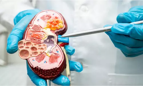 Kidney Stone Diet: किडनी स्टोन की समस्या से हैं परेशान तो जानें क्या खाएं और क्या न खाएं