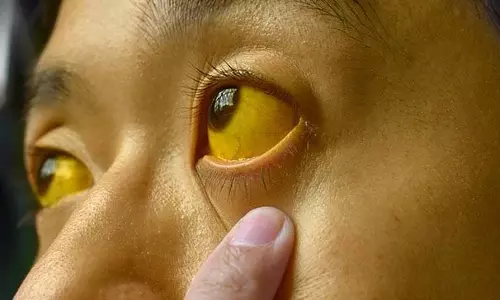 Jaundice : गर्मियों में पीलिया होने का खतरा Jaundice : गर्मियों में पीलिया होने का खतरा