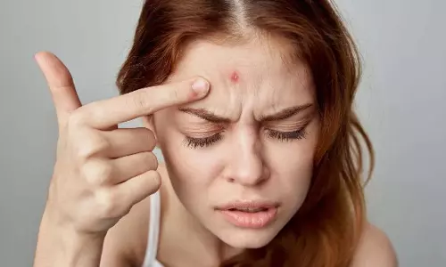 माथे पर मुंहासे: उन्हें रोकने के 7 सिद्ध तरीके माथे पर मुंहासे: उन्हें रोकने के 7 सिद्ध तरीके