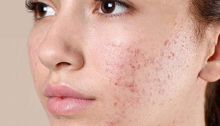 Skin Care: अगर आपके चेहरे पर बार-बार पिंपल्स आते हैं, तो ये 6 कारण हो सकते हैं जिम्मेदार Skin Care: अगर आपके चेहरे पर बार-बार पिंपल्स आते हैं, तो ये 6 कारण हो सकते हैं जिम्मेदार