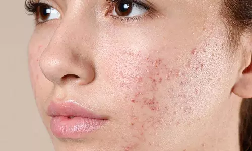 Skin Care: अगर आपके चेहरे पर बार-बार पिंपल्स आते हैं, तो ये 6 कारण हो सकते हैं जिम्मेदार Skin Care: अगर आपके चेहरे पर बार-बार पिंपल्स आते हैं, तो ये 6 कारण हो सकते हैं जिम्मेदार