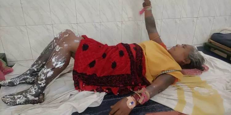एम्बुलेंस में ऑक्सीजन सिलेंडर फटने से महिला गंभीर रूप से झुलसी एम्बुलेंस में ऑक्सीजन सिलेंडर फटने से महिला गंभीर रूप से झुलसी