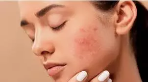 Skin care: चेहरे की सफाई के बाद गलती से भी न करें ये काम, वरना त्वचा पर आने लगेंगे पिंपल्स Skin care: चेहरे की सफाई के बाद गलती से भी न करें ये काम, वरना त्वचा पर आने लगेंगे पिंपल्स