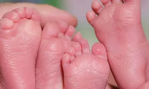 भोपाल में महिला ने समय से पहले चार बच्चों को दिया जन्म; शिशुओं का वजन 1 किलो से कम