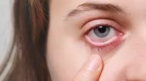 Health: लू से आंखों को हो सकता है बड़ा नुकसान, जानिए गर्मियों में कैसे रखें ख्याल Health: लू से आंखों को हो सकता है बड़ा नुकसान, जानिए गर्मियों में कैसे रखें ख्याल