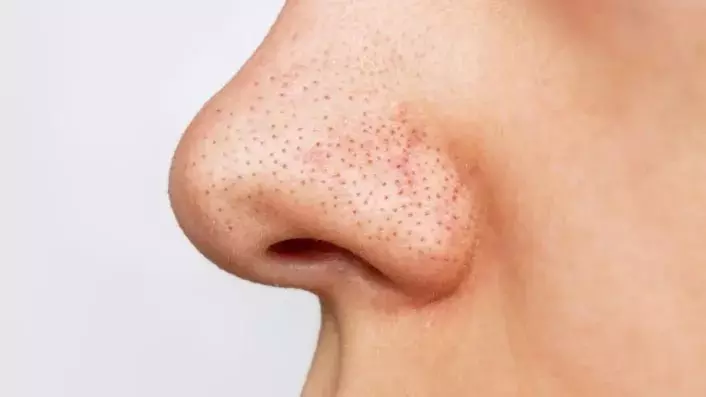 Blackhead Hacks: नींबू के इस नुस्खे से 5 मिनट में गायब हो जाएंगे ब्लैकहेड्स Blackhead Hacks: नींबू के इस नुस्खे से 5 मिनट में गायब हो जाएंगे ब्लैकहेड्स