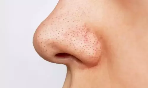 Blackhead Hacks: नींबू के इस नुस्खे से 5 मिनट में गायब हो जाएंगे ब्लैकहेड्स Blackhead Hacks: नींबू के इस नुस्खे से 5 मिनट में गायब हो जाएंगे ब्लैकहेड्स