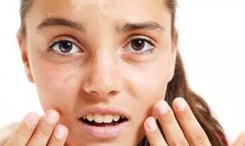 Skin care: धूप से झुलसी त्वचा को दें राहत, घर लौटते ही लगाएं ये चीजें, टैनिंग भी होगी कम Skin care: धूप से झुलसी त्वचा को दें राहत, घर लौटते ही लगाएं ये चीजें, टैनिंग भी होगी कम