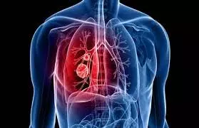 Health: कमजोर फेफड़ों को मजबूत और स्वस्थ बनाते हैं ये योगासन Health: कमजोर फेफड़ों को मजबूत और स्वस्थ बनाते हैं ये योगासन