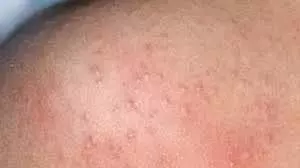 Prickly Heat Home Remedies: भीषण गर्मी में घमौरियों से बचने के लिए अपनाएं ये असरदार घरेलू उपाय Prickly Heat Home Remedies: भीषण गर्मी में घमौरियों से बचने के लिए अपनाएं ये असरदार घरेलू उपाय