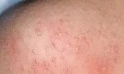 Prickly Heat Home Remedies: भीषण गर्मी में घमौरियों से बचने के लिए अपनाएं ये असरदार घरेलू उपाय