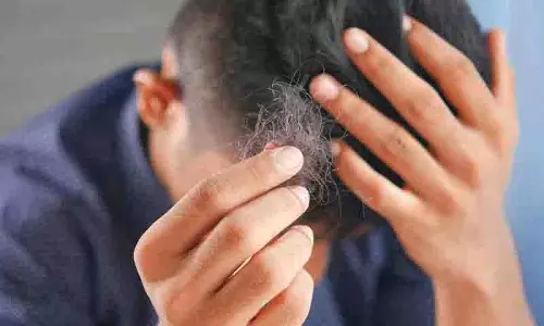 Hyderabad: गंजेपन के इलाज का घोटाला पकड़ा गया, बाल दोबारा उगाने के झूठे वादे से लोगो को ठगा